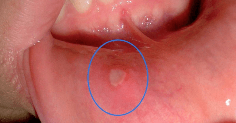 oral lesion