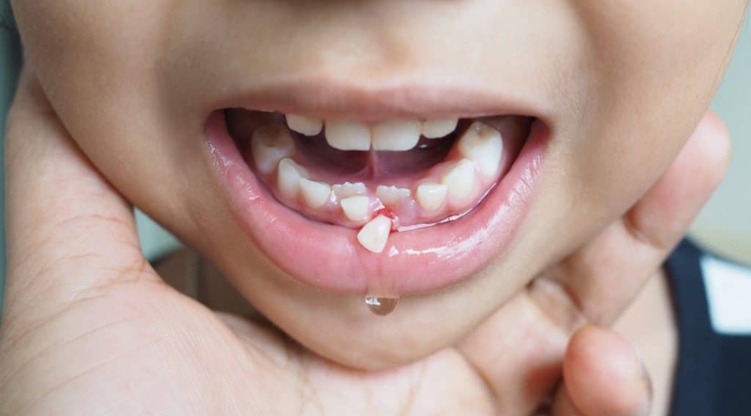 First Aid for Dental Injuries What You Need to Know