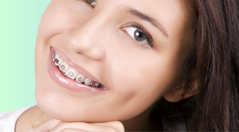 How to Choose the Right Type of Braces for Your Needs in Aurangabad