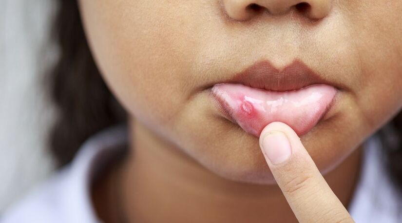 Initial Signs and Symptoms of Oral Tumor