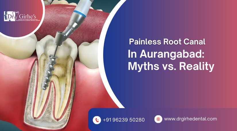 Painless Root Canal in Aurangabad
